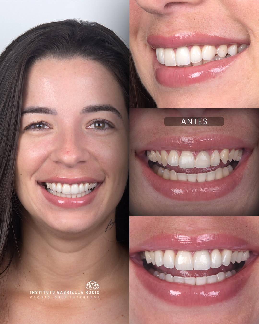 Antes e depois — Caso clínico