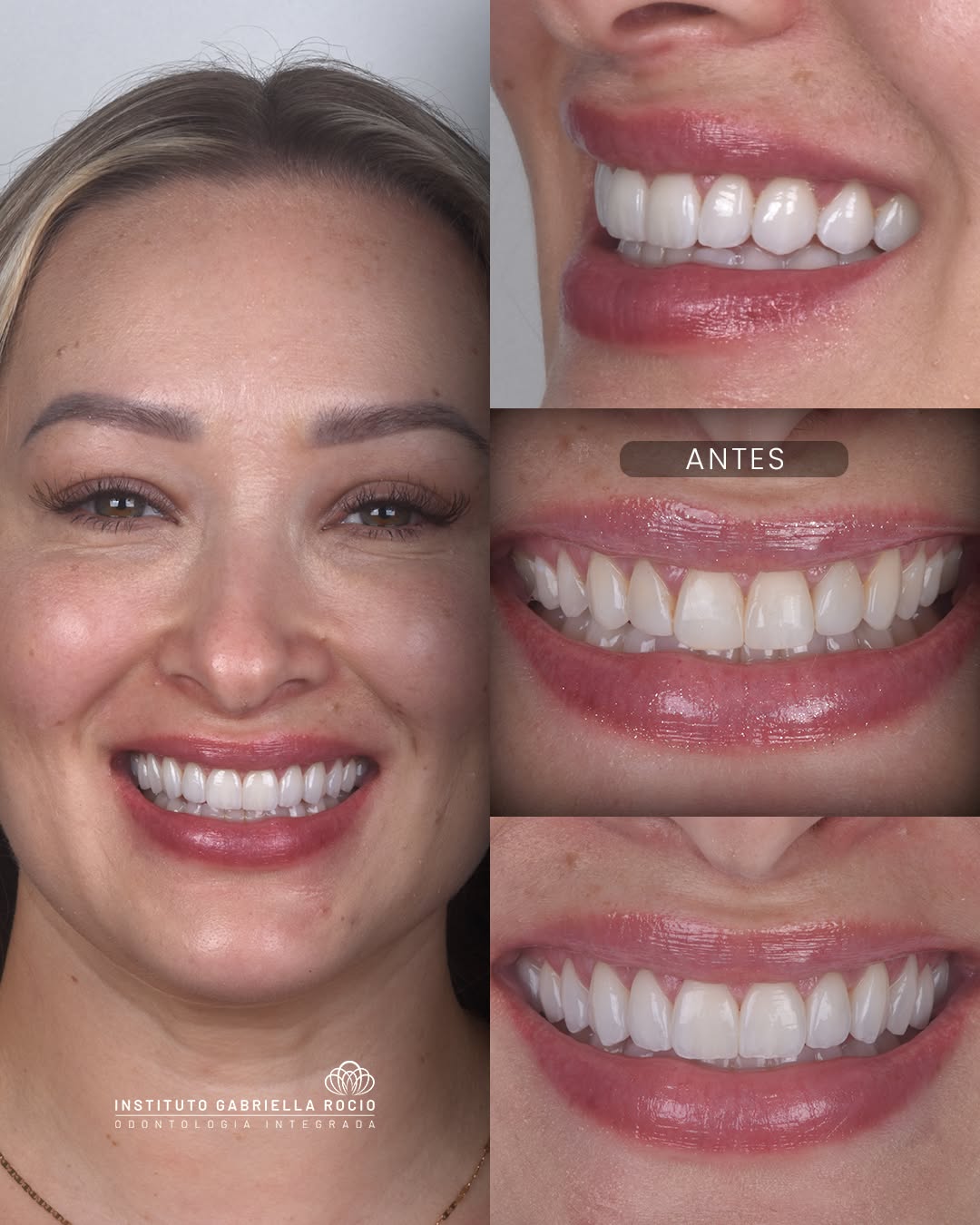 Antes e depois — Harmonia do sorriso