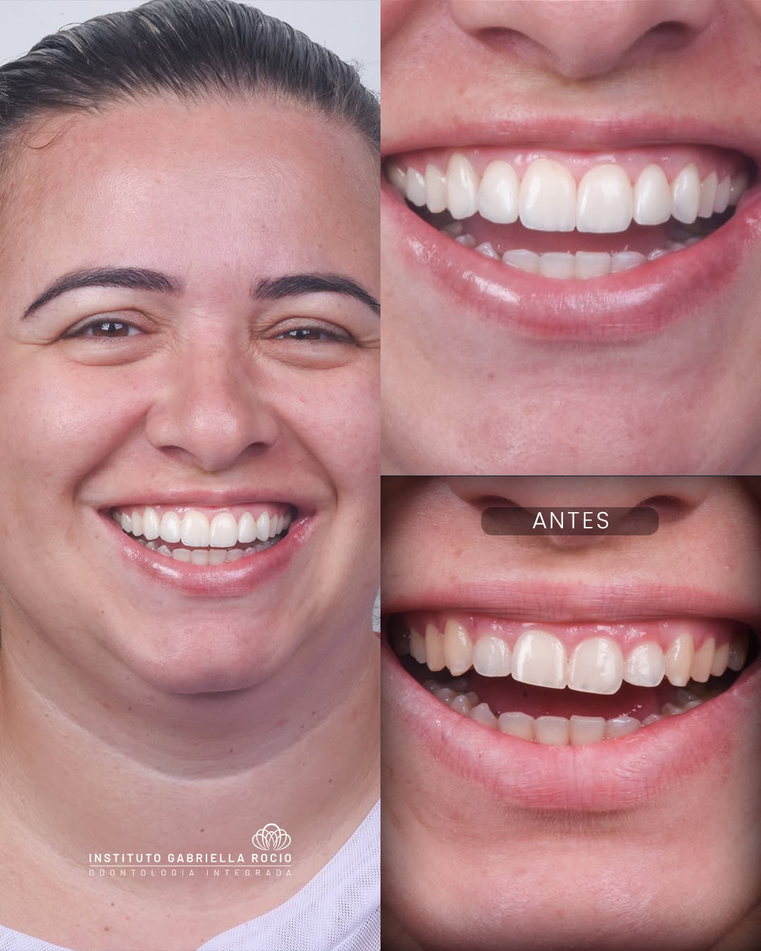 Antes e depois — Lentes de contato