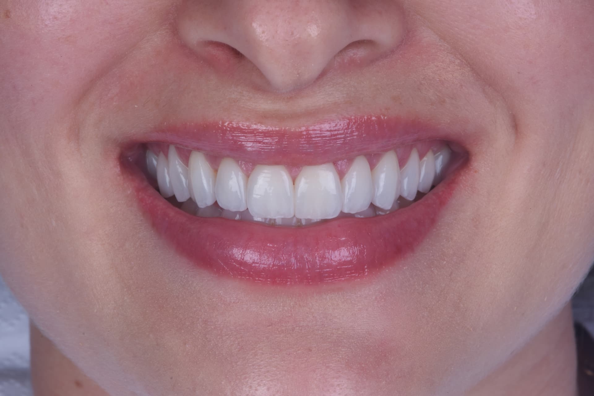 Lentes de Contato Dental em Porcelana