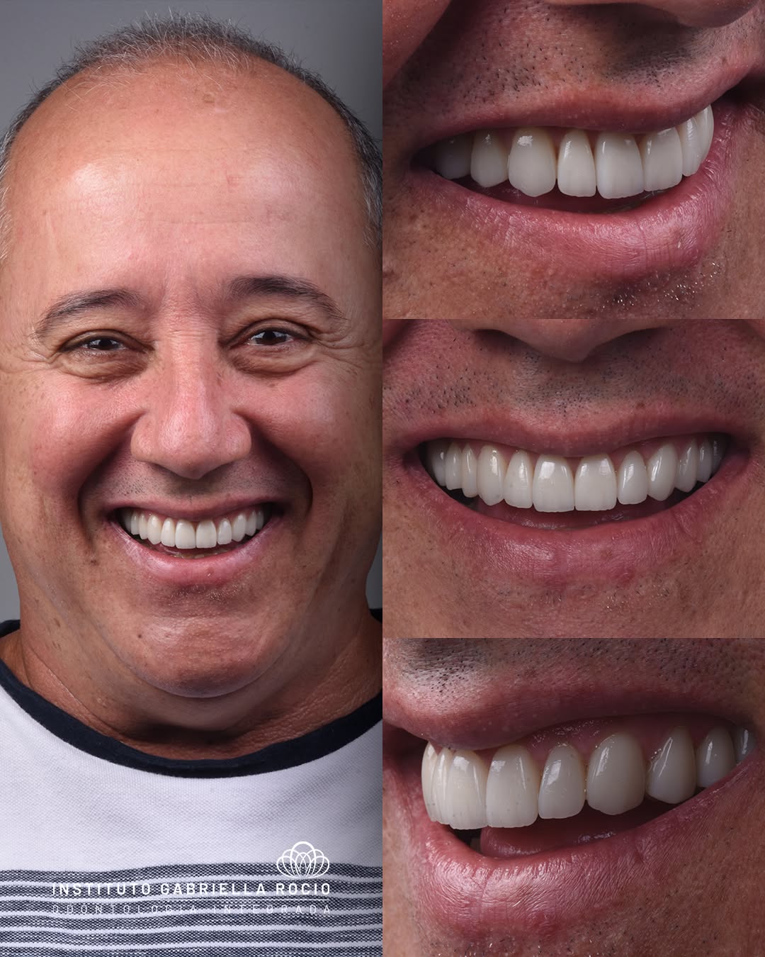Antes e depois — Reabilitação estética