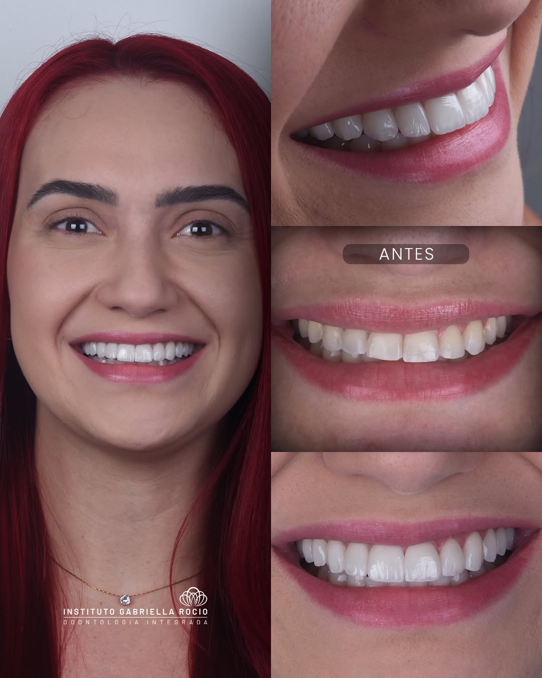 Antes e depois — Sorriso renovado