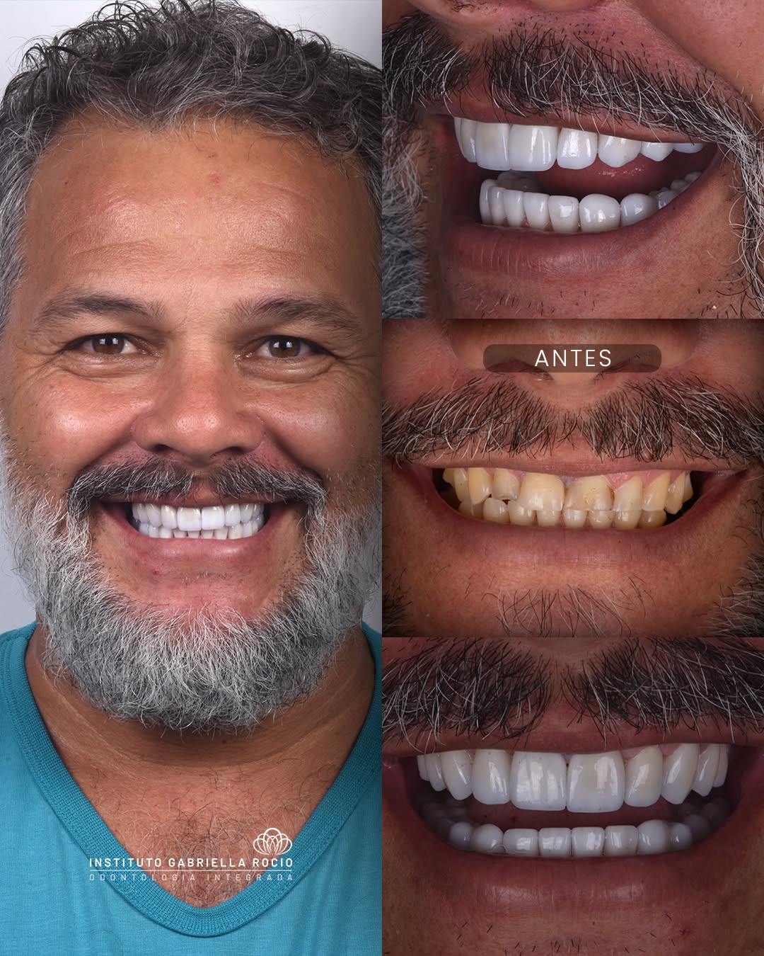 Antes e depois — Facetas cerâmicas