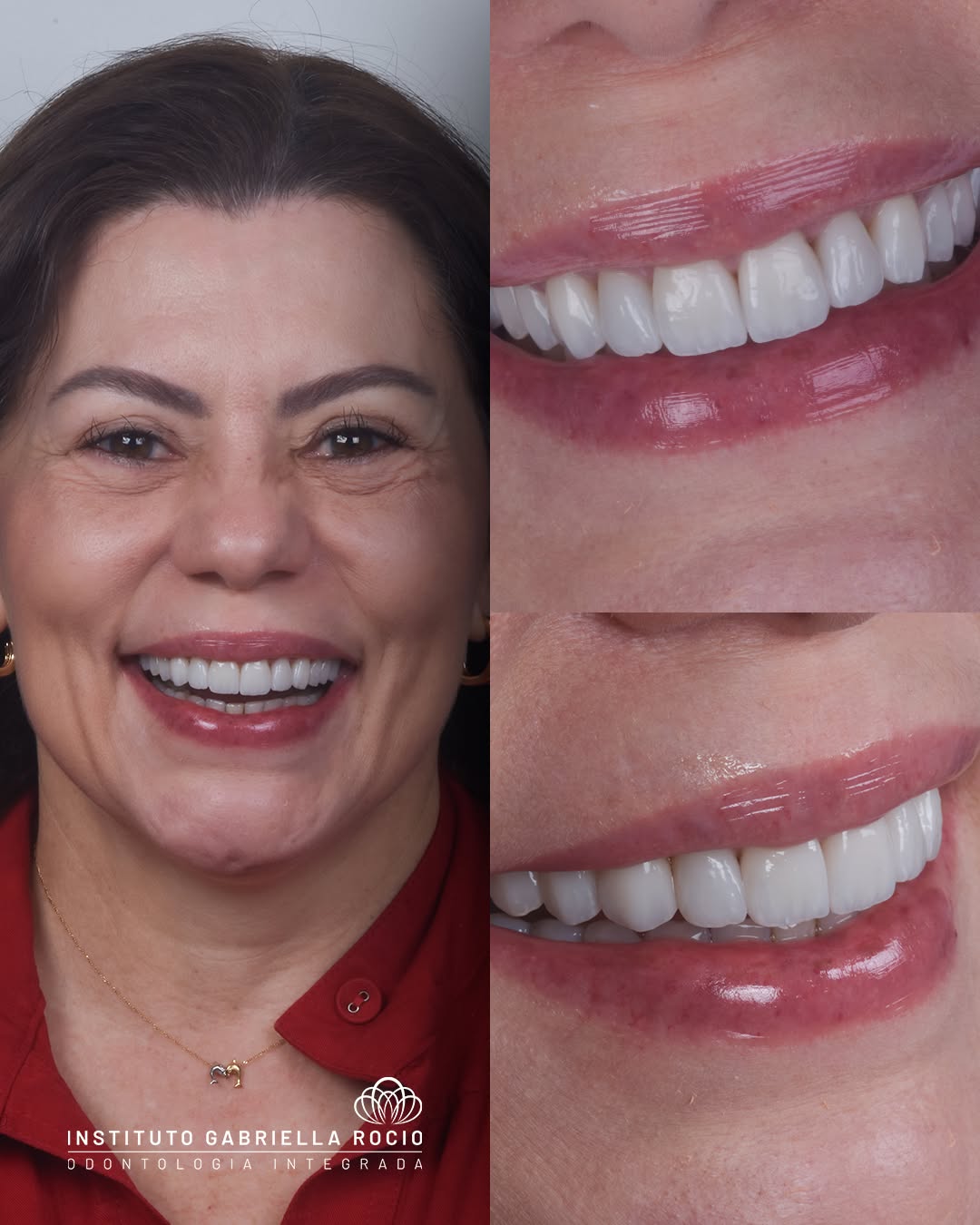 Antes e depois — Transformação do sorriso